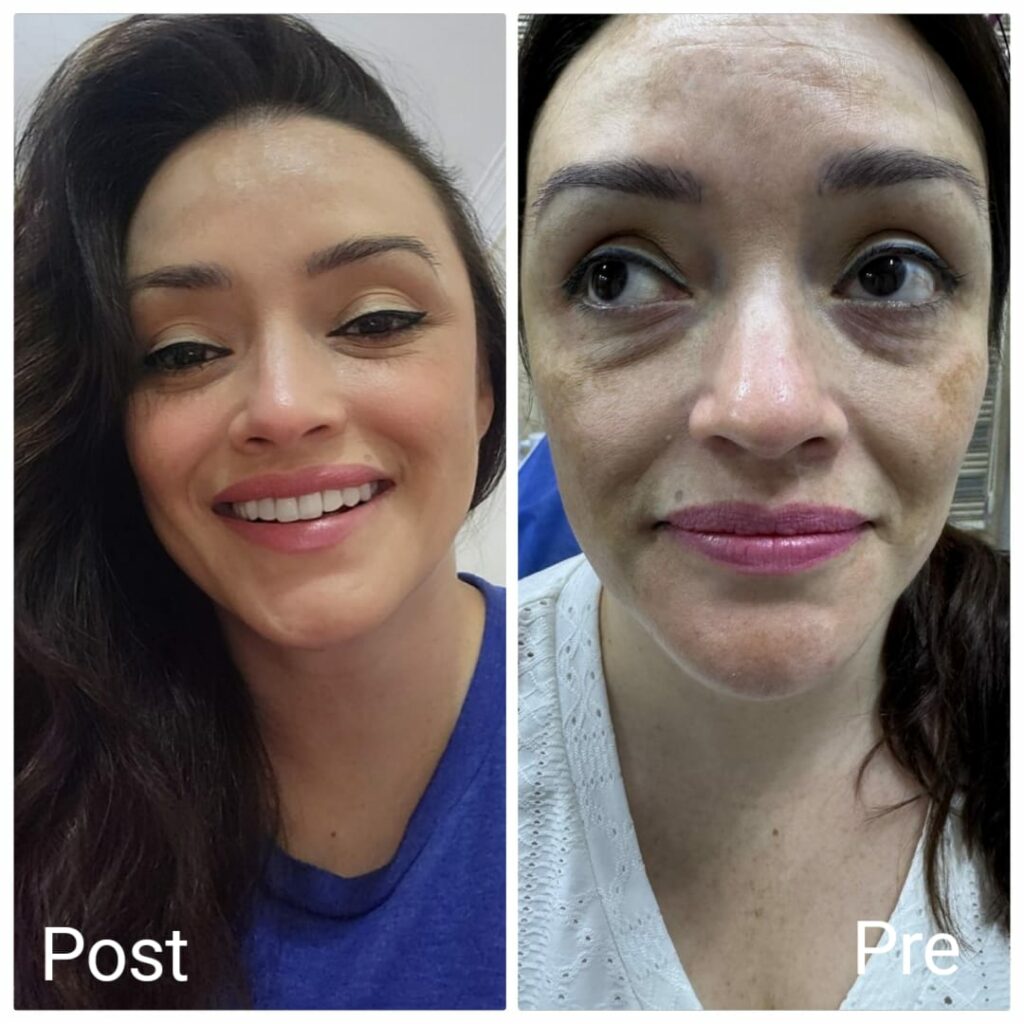 قبل و بعد فيلر للوجه و تحت العين